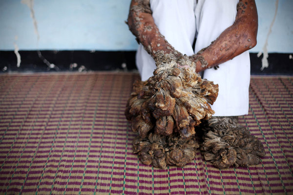 印尼男子四肢长满枝根状肉瘤 得怪病变"树人"