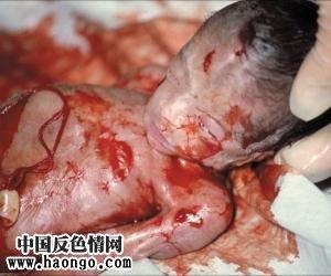 [转贴]打胎后胎儿的真实照片(36图心理承受弱,心脏病勿入!
