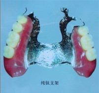 齿科铸造用纯钛制作总义齿基托及可摘义齿金属支架的临床效果